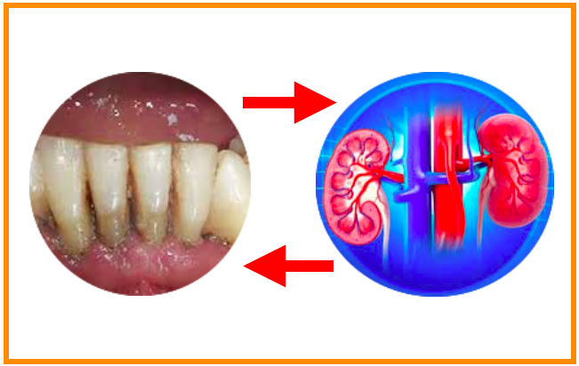 Pesquisa sobre a ligação entre as doenças  gengivais e doenças renais