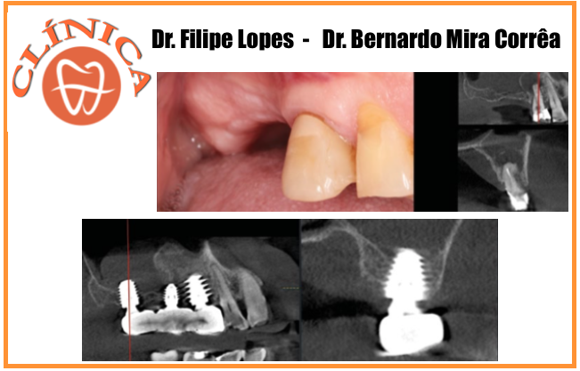 Caso Clínico, follow-up  3 anos—  Dr. Filipe Lopes e Dr. Bernardo Mira Corrêa