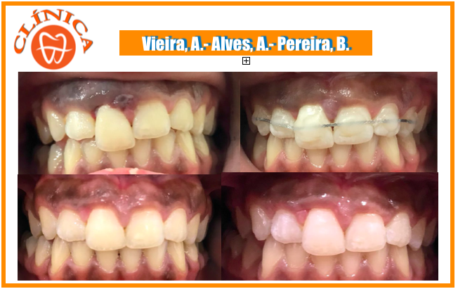 Traumatologia em Odontopediatria, a propósito de um Caso Clínico