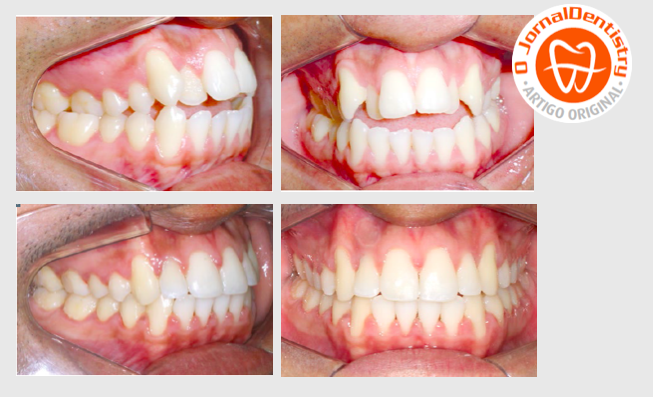 As evidências Clínicas do tratamento com Ortodontia Autoligável: Filosofia BTM