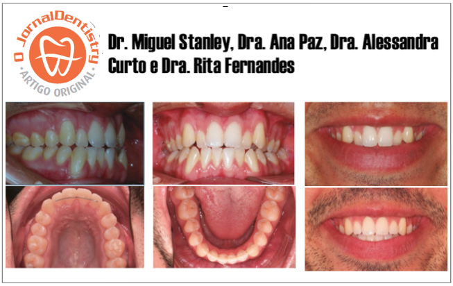 Abordagem Multidisciplinar de uma má oclusão dentária e perturbação miofuncional através da Ortodontia e Terapia da Fala