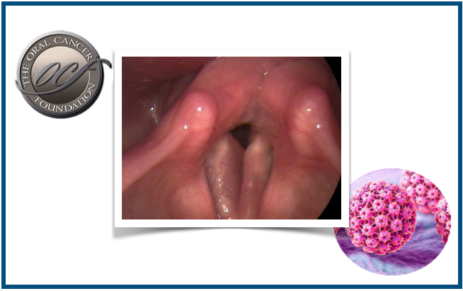 A infeção por VPH pode estar por trás do aumento do cancro das cordas vocais entre os jovens não fumadores