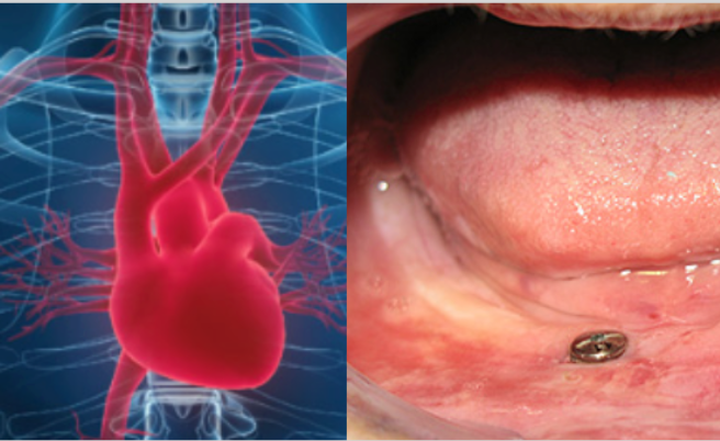 Estudo mostra que pacientes com doença coronária e edêntulos têm quase o dobro do risco de morte