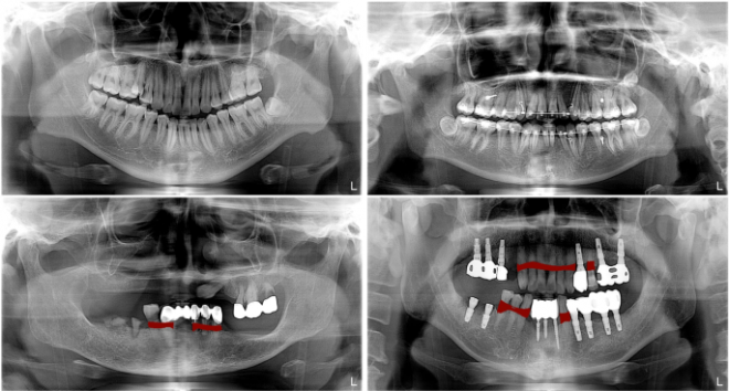 dentalXrai Pro — programa de software para analise de radiografias