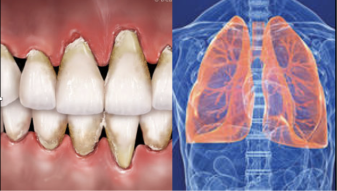Doença da gengiva grave está associada a função pulmonar deficiente