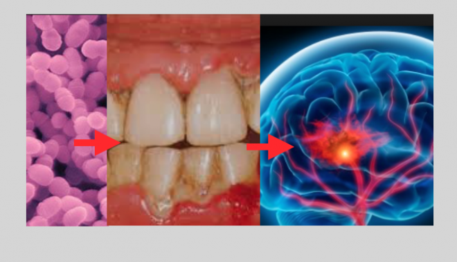 Bactérias Orais ligadas ao risco de AVC