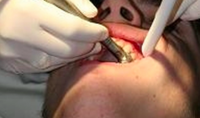 Higiene oral preventiva pode reduzir as obturações no tratamento de cáries  dentária
