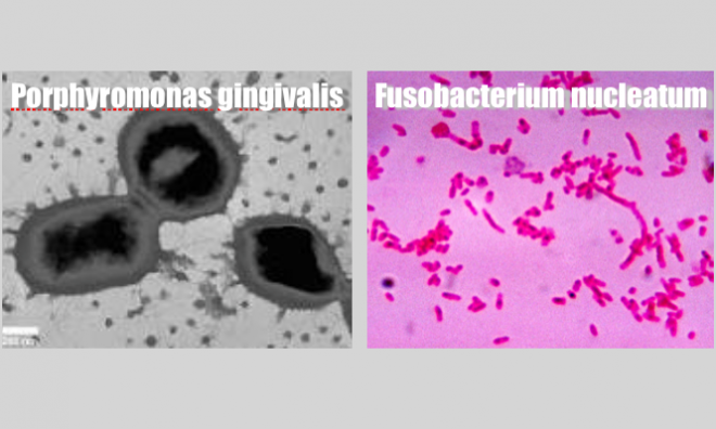 As bactérias causadoras de doenças gengivais podem levar ao desenvolvimento do cancro oral