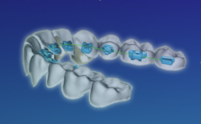 Pandemia desencadeia inovações importantes na ortodontia digital