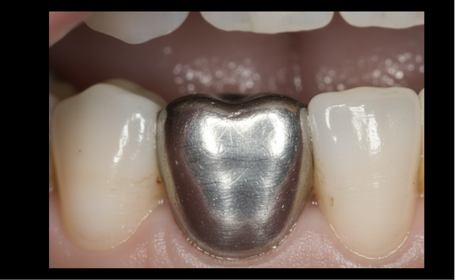 2034  data da eliminação da amálgama dentária
