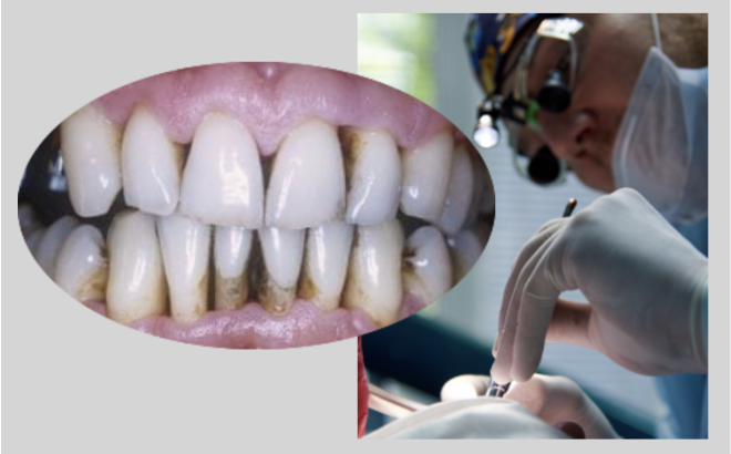 ProtótipoT para deteção da periodontite está a ser  desenvolvio pela a Universidade de Birminghan
