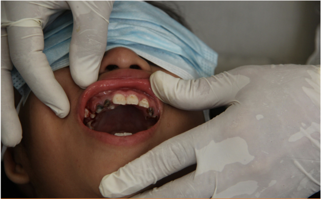 Inquérito Nacional sobre Saúde oral do Hospital Infantil C.S. Mott da Universidade de Michigan