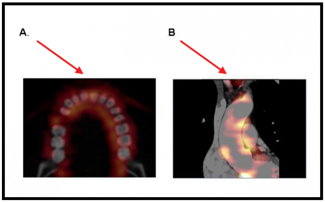 A doença periodontal aumenta o risco de eventos cardiovasculares mais graves