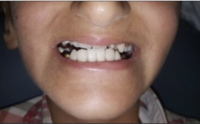 Anomalias dentárias entre sobreviventes de cancro infantil dependem do tratamento recebido