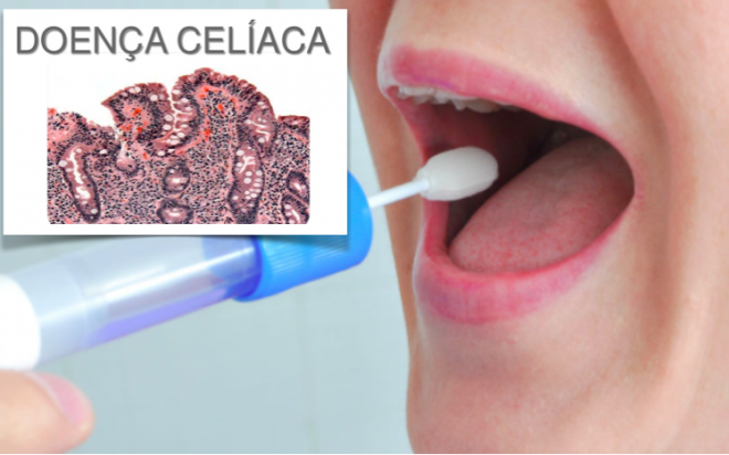 Enzima isolada de bactérias presentes na saliva humana tem potencial na terapia da Doença Celíaca (DC)