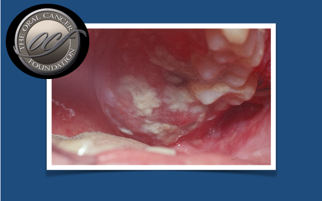 “Gates of Heaven” – a proteína que alimenta a dor e a progressão do cancro oral