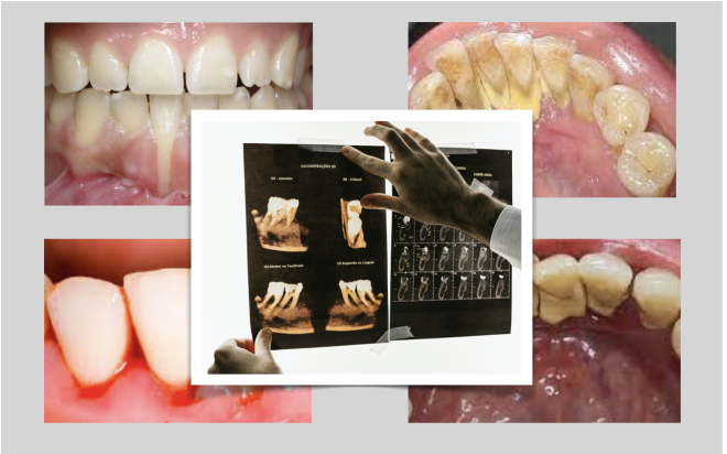 Rastreio da doença periodontal para melhorar o diagnóstico e o tratamento