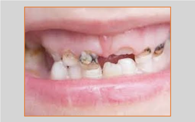 Prevenção da cárie dentária em crianças