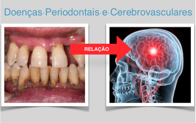 Ligações entre doenças periodontais e cerebrovasculares