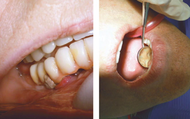 A importância das consultas de controlo de higiene oral na prevenção das doenças implantares