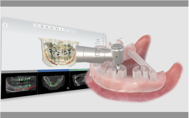 O OneGuide da Osstem Implant celebra o seu 10.º aniversário, reforçando a sua competitividade na medicina dentária digital