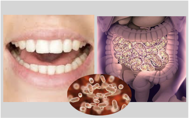 Bactérias orais podem ser uma causa da doença de Crohn