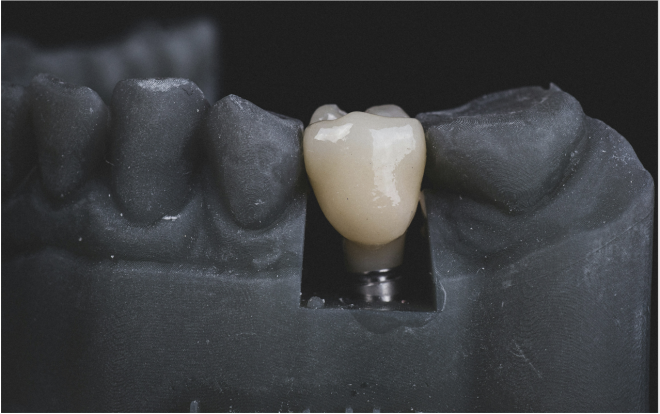 Implantologia dentária com auxílio da robótica e da IA