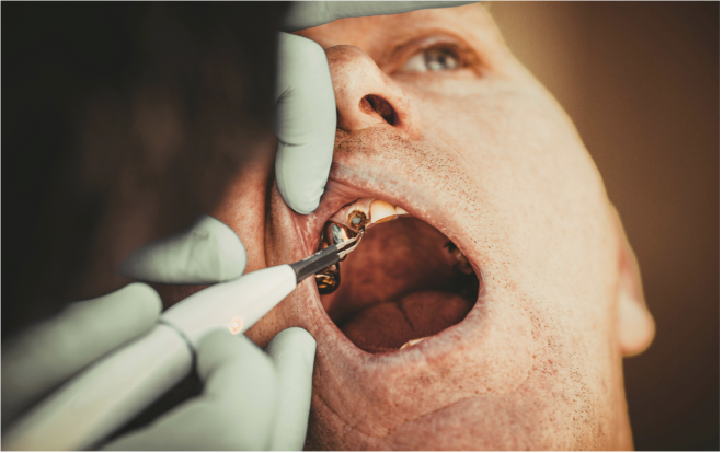 As infeção dentária silenciosa pode estar a prejudicar todo o seu corpo.