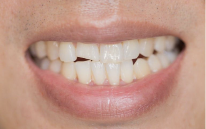 Médicos Dentistas dizem que o stresse COVID-19 está a afetar a nossa saúde dentária
