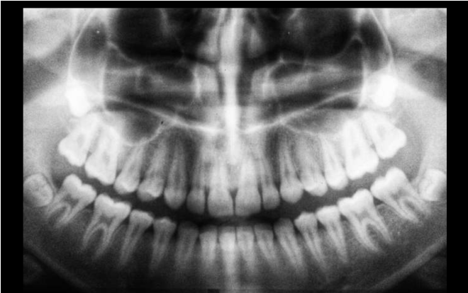 IA identifica sexo biológico usando raios-X dentários