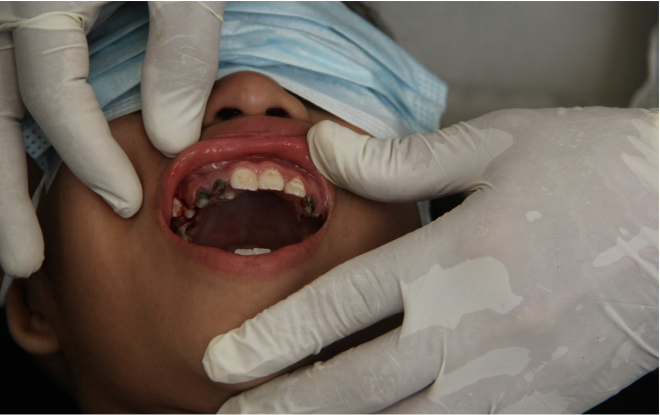 Tratar uma infeção dentária pode melhorar o açúcar no sangue e a saúde do coração