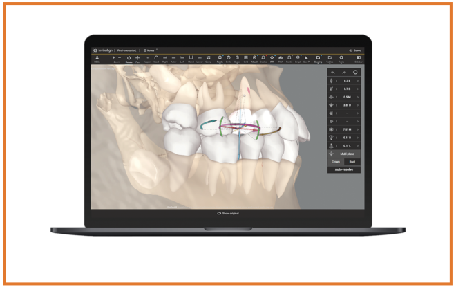 Align Technology  lança inovação para Sistema  InvisaIign