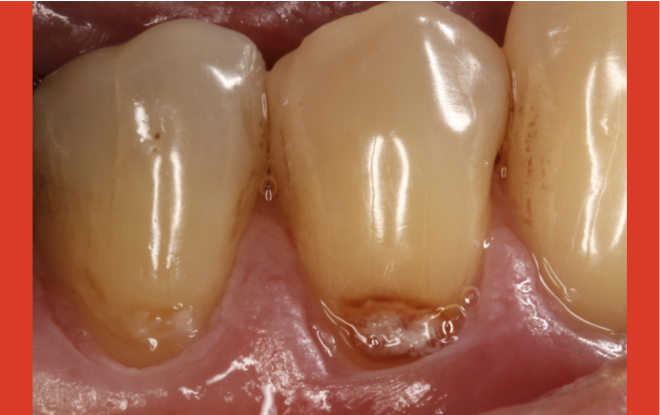 Novo protótipo de equipamento dentário pode detetar as condições ácidas que levam a cáries