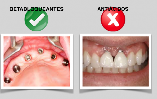 Por que razão é que alguns implantes dentários funcionam e outros não