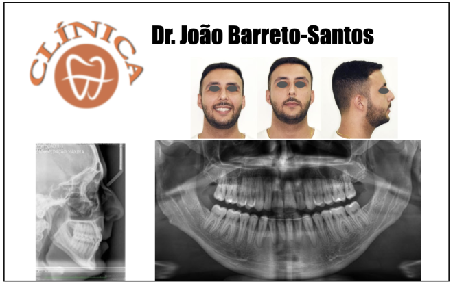 Tratamento de mordida aberta anterior com recurso a alinhadores e ancoragem esquelética: caso clínico