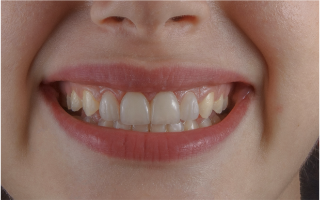 Estudo revela que manter os dentes pode adicionar anos de vida independente