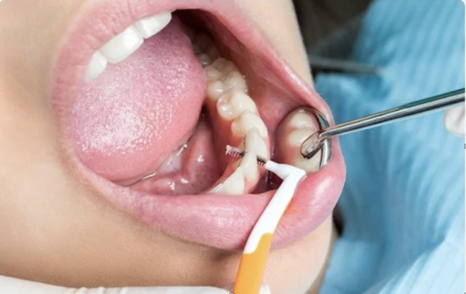 Cuidados dentários podem beneficiar doentes agendados para cirurgia do cancro