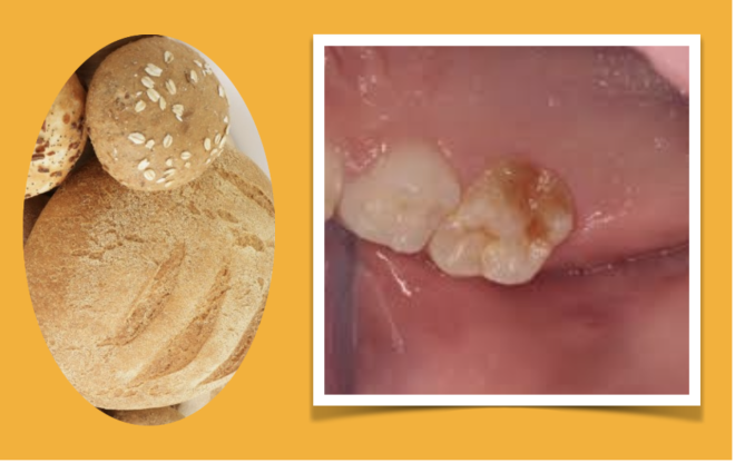 Danos no esmalte dentário em pacientes com Doença Celíaca podem ser causados por uma reação autoimune