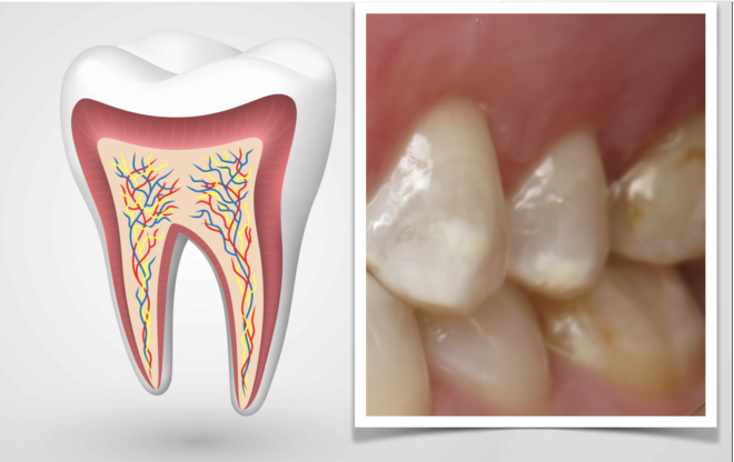 Passo importante para o desenvolvimento do esmalte dentário biológico