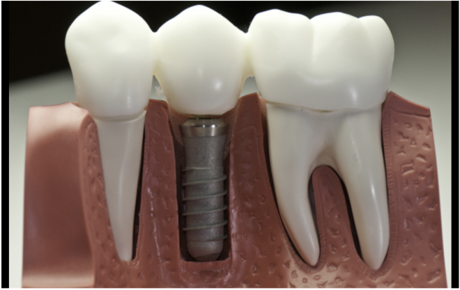 Estudo sobre o desempenho das superfícies do implante dentário