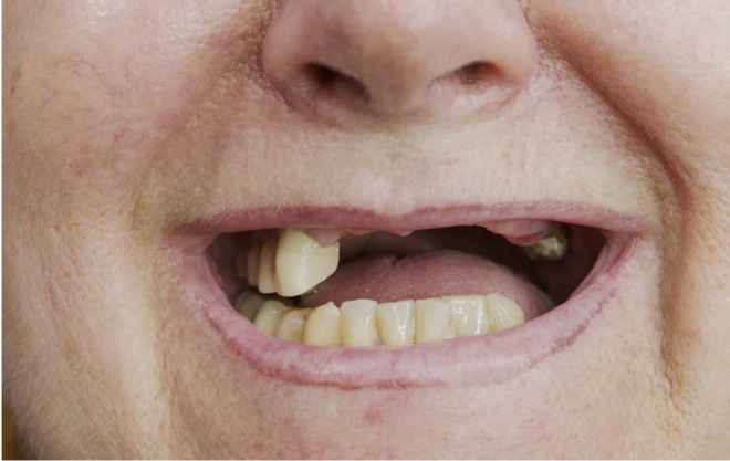 Uma boa saúde oral, incluindo dentaduras, pode proteger contra o declínio cognitivo