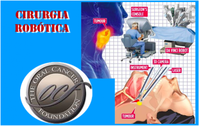 Cirurgia Robótica Transoral (TORS) para remoção de cancros na garganta