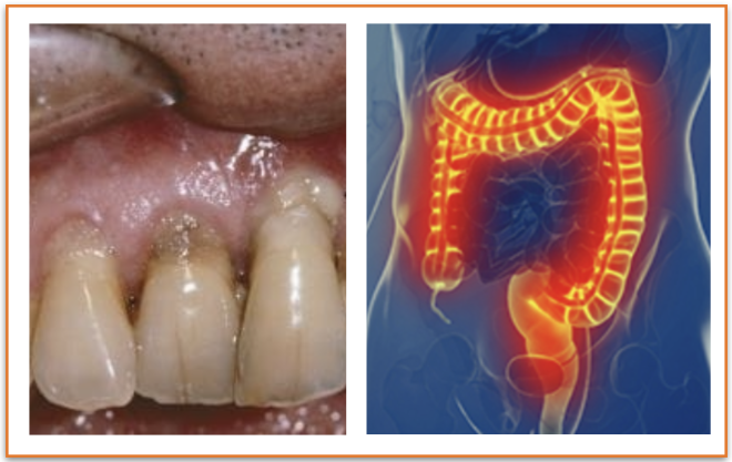 Poderá a cura da Doença Inflamatória Intestinal  (DII) pode estar na boca?