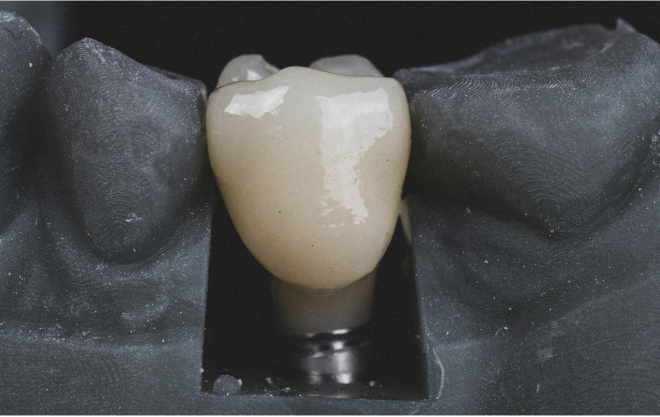 Descoberta a razão porque   os antibióticos falham contra uma doença comum nos implantes dentários