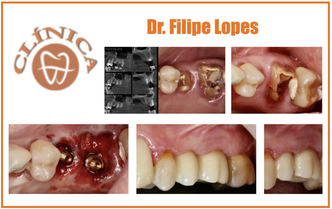 Carga imediata em implantes pós-extração reverse PET nos dentes 25 e 26 com uma ponte final Cad/Cam em zirconia
