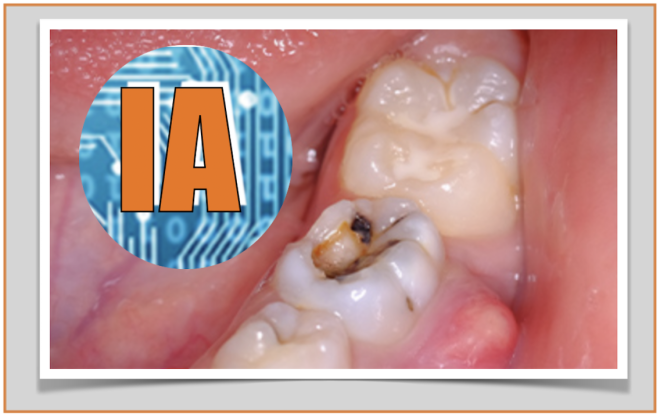 Deteção de cáries dentárias com auxílio da IA