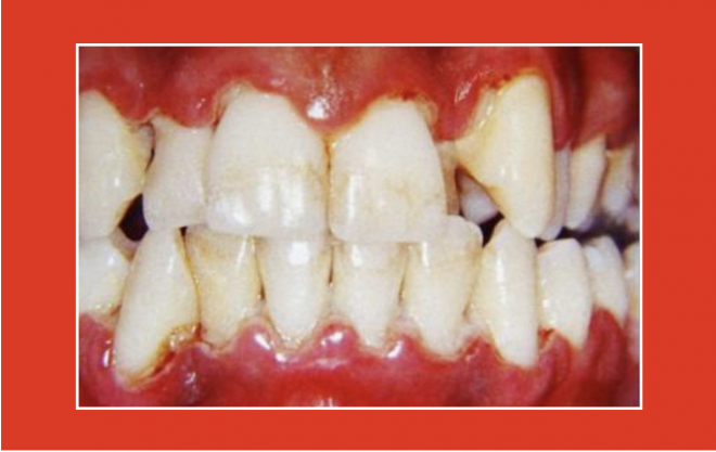 Identificar os fatores de risco para a perda de dentes