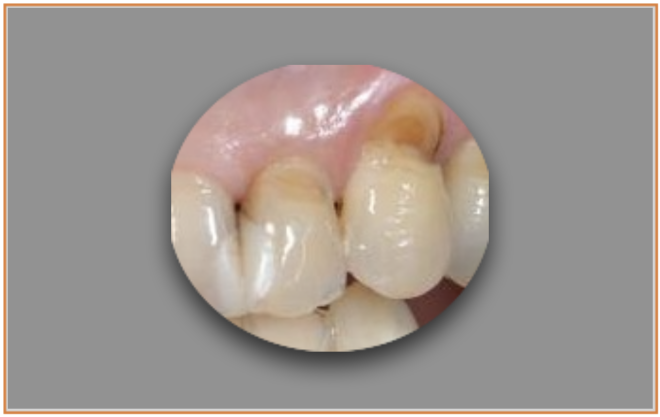 Os fitólitos e o teor de água nas plantas influenciam a taxa de abrasão do esmalte dentário nos vertebrados