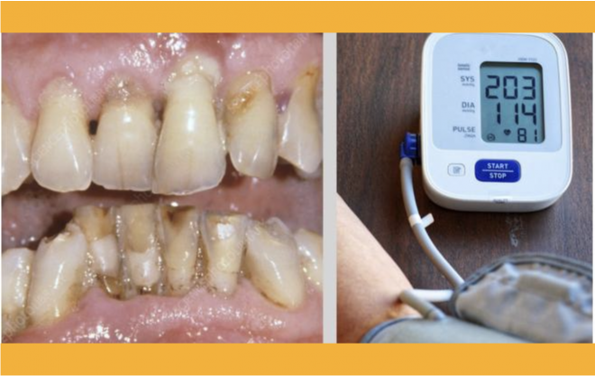 Pessoas com periodontite podem ter duas vezes mais probabilidades de serem hipertensos