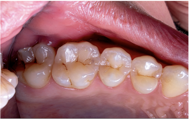 Sistema de IA prevê cáries na primeira infância em dentes individuais com elevada precisão